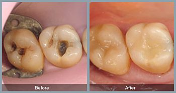 Amalgam Removal