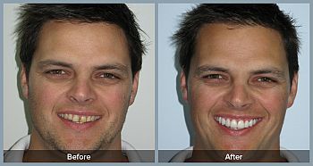 Cosmetic Dentistry and Smile Makeovers